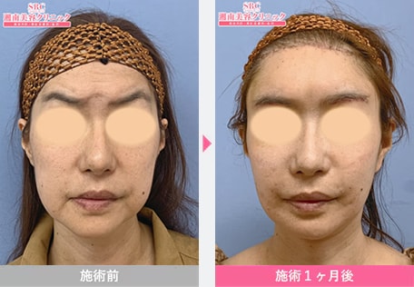 リフトアップ・たるみ解消 症例写真