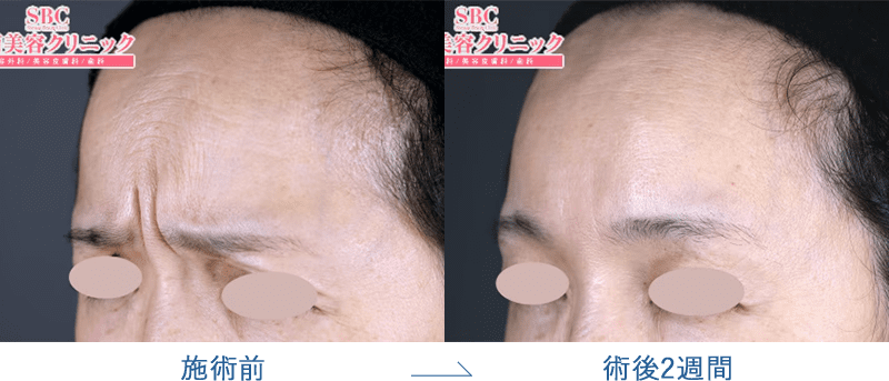 ボトックス(アラガン)の眉間・おでこのシワ改善症例