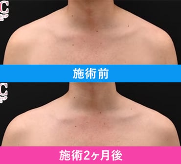 PICKUP症例3