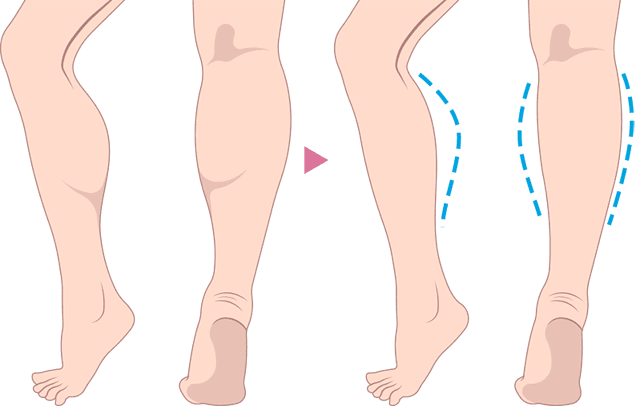 ふくらはぎのボトックス痩身　施術方法