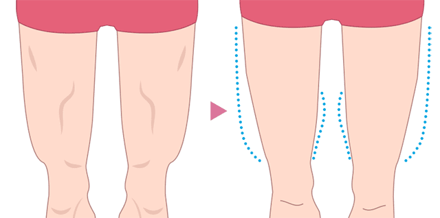 二の腕のボトックス痩身　施術方法