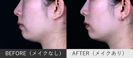 人中短縮ボトックスの症例写真（横顔）