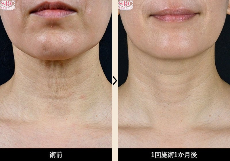 症例写真 Before After