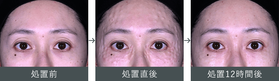 女優注射®~リジュラン+ボトックス~ ダウンタイムの症例