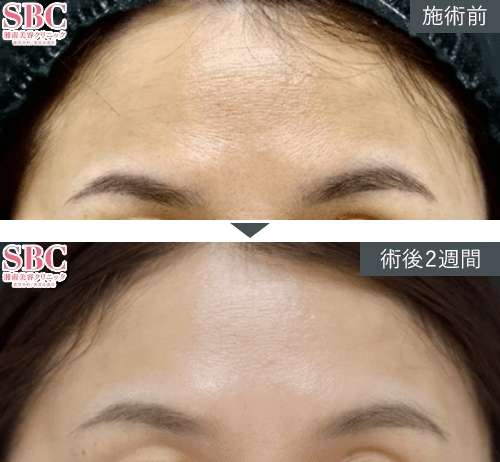 女優注射®~リジュラン+ボトックス~症例写真(額)PICKUP1 Before After