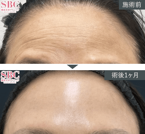 女優注射®~リジュラン+ボトックス~症例写真(額)PICKUP2 Before After