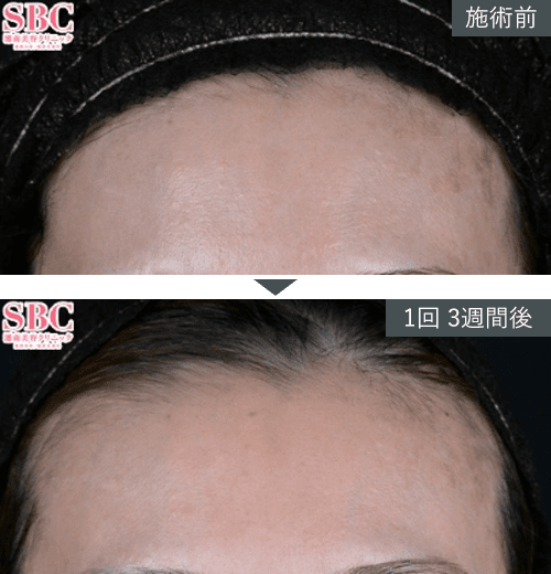 女優注射®~リジュラン+ボトックス~症例写真(額)1 Before After