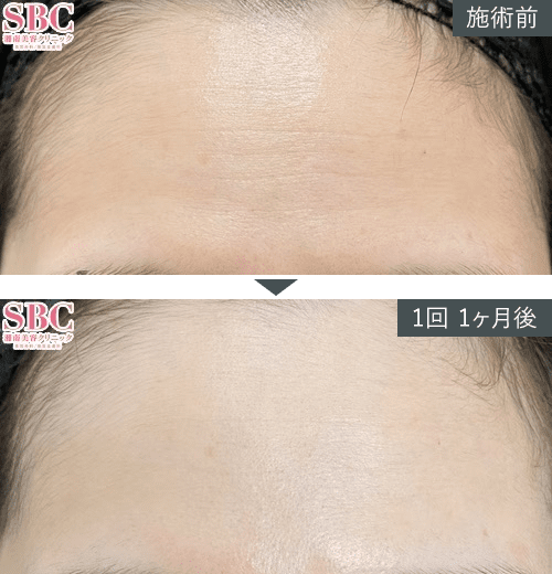 女優注射®~リジュラン+ボトックス~症例写真(額)2 Before After