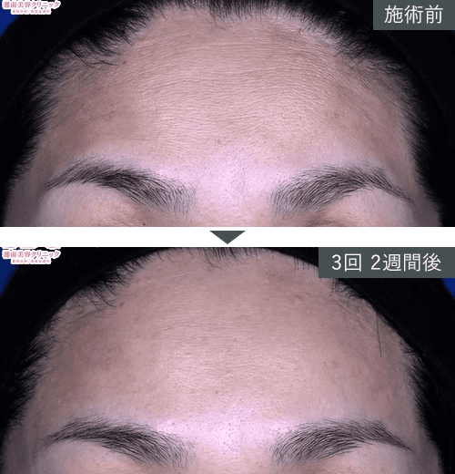 女優注射®~リジュラン+ボトックス~症例写真(額)4 Before After