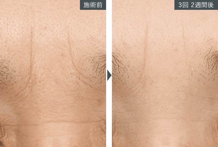 女優注射®~リジュラン+ボトックス~症例写真(額)4 Before After