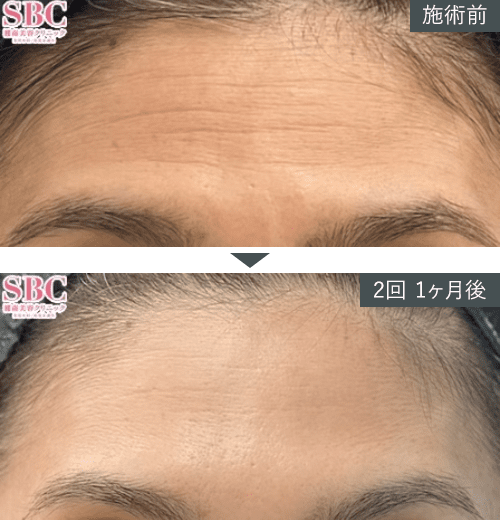 女優注射®~リジュラン+ボトックス~症例写真(額)4 Before After