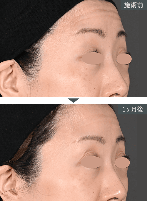 女優注射®~リジュラン+ボトックス~症例写真(額) Before After