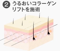 うるおいコラーゲンリフトを施術
