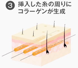 挿入した糸の周りにコラーゲンが生成