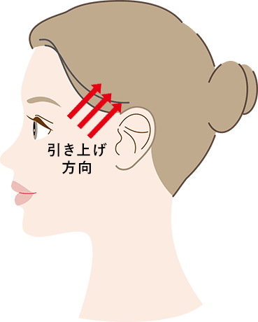 こめかみリフトのイメージイラスト