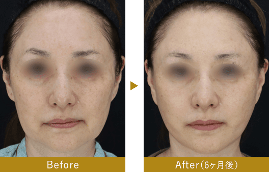 Deep Plane Facelift or High SMAS（ネック込み）　before after