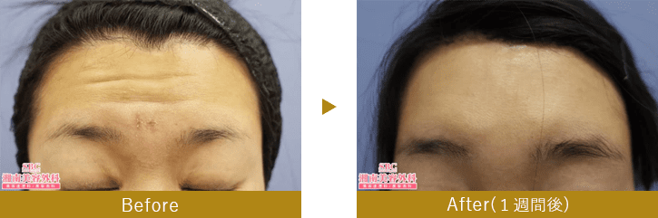 切開リフト（前額リフト）　before after