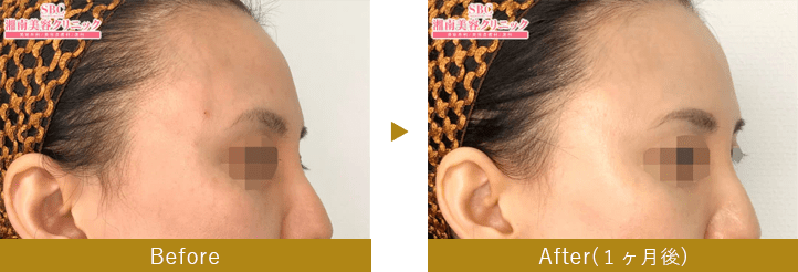 切開リフト（こめかみリフト）　before after
