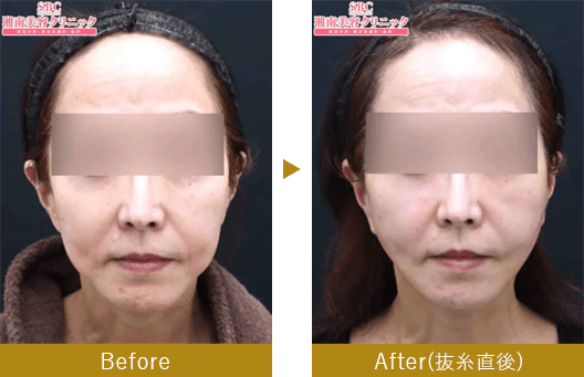 切開リフト（ナチュラルクイック・MACSリフト）　before after