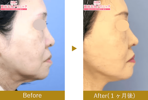 ネックリフト before after