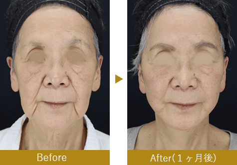 Deep Plane Facelift or High SMAS（ネック込み）　before after