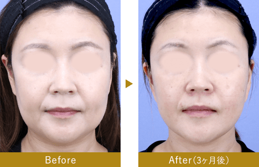 切開リフト（SMASフェイスネックリフト）　before after