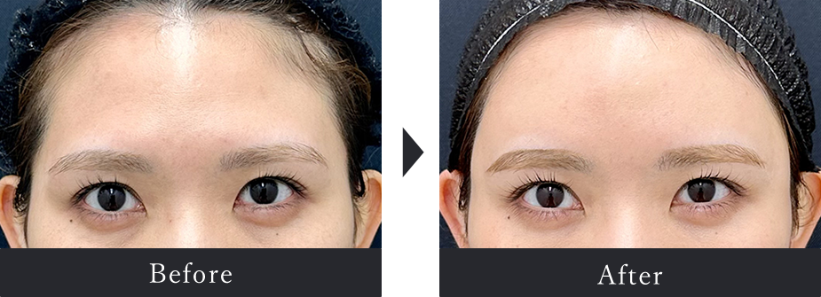 Before After