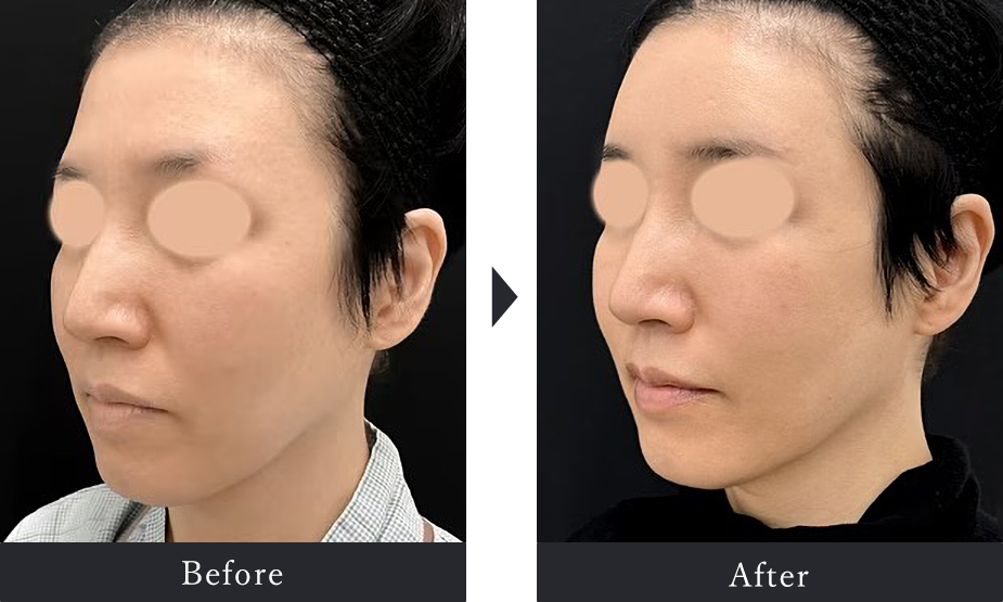 Before After