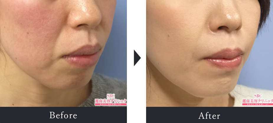 Before After