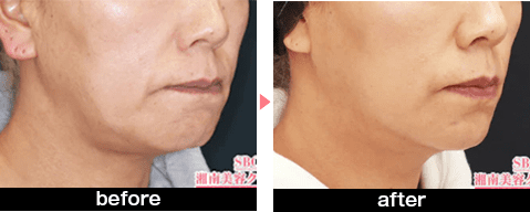 VOV（ボブ）リフトの症例写真before・after