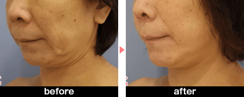 ナチュラルクイック・MACSリフトの症例写真before・after