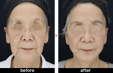 SMASフェイスネックリフトの症例写真before・after