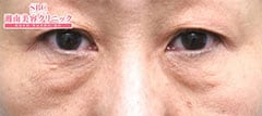 アイバックリムーブ症例写真5 Before