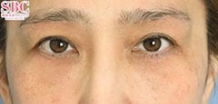 アイバックリムーブ症例写真2 After