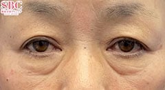 アイバックリムーブ症例写真3 Before