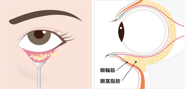 眼窩脂肪を調整