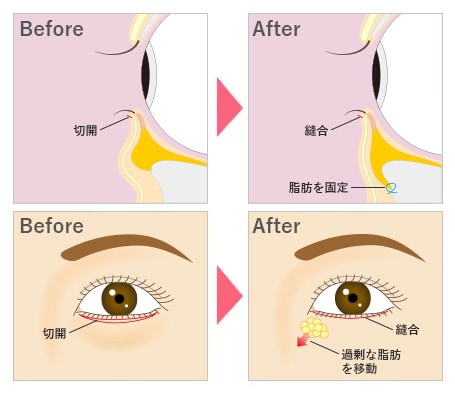 切開ハムラ(表ハムラ)法の施術方法