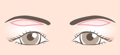 皮膚切除のデザイン