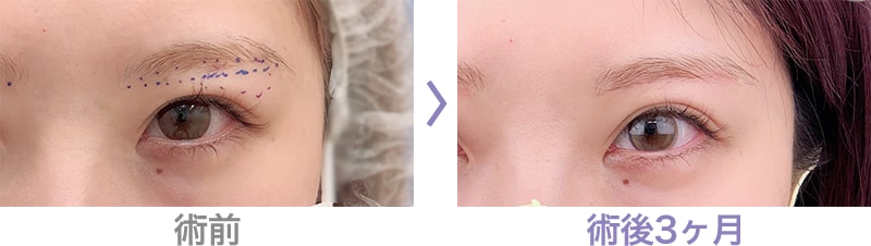 眉下リフト（眉下切開）はこのような方におすすめ 症例写真1