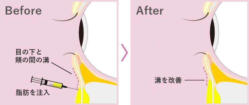 脂肪注入