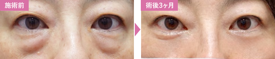 裏ハムラ法症例写真2