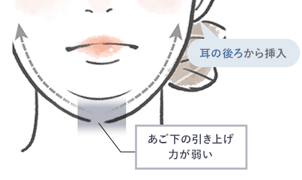 顎下すっきリフト（アンカーDXダブル）と他の糸との違い イメージ2