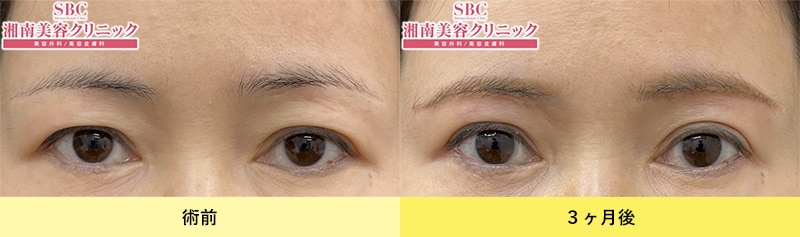 眉下リフト（眉下切開）症例写真
