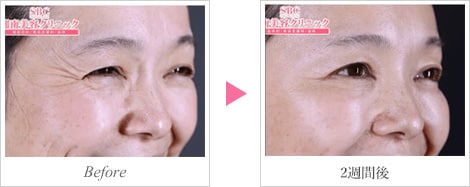 目尻のしわ