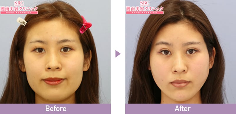 シークレットリフト症例写真
