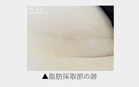 脂肪採取部へのこだわり