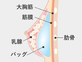 乳腺下法