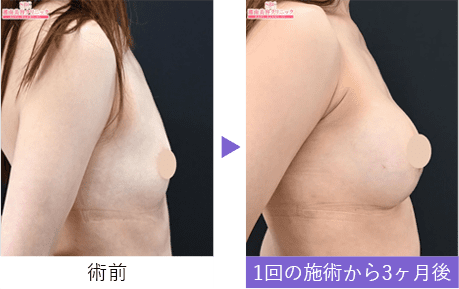 【豊胸・バストの修正】豊胸インプラントバッグMESMO（メスモ）
