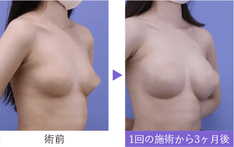 【豊胸・バストの修正】豊胸インプラントバッグMESMO（メスモ）, 内視鏡下バッグ豊胸
