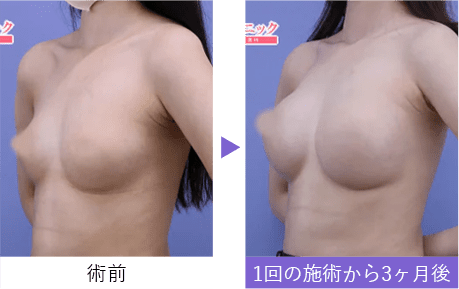 【豊胸・バストの修正】豊胸インプラントバッグMESMO（メスモ）, 内視鏡下バッグ豊胸
